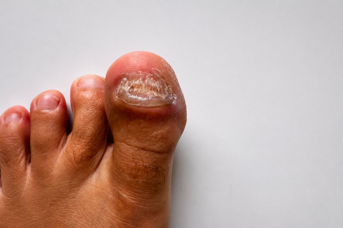 Nagelpilz Tabletten Erfahrung am Zehennagel