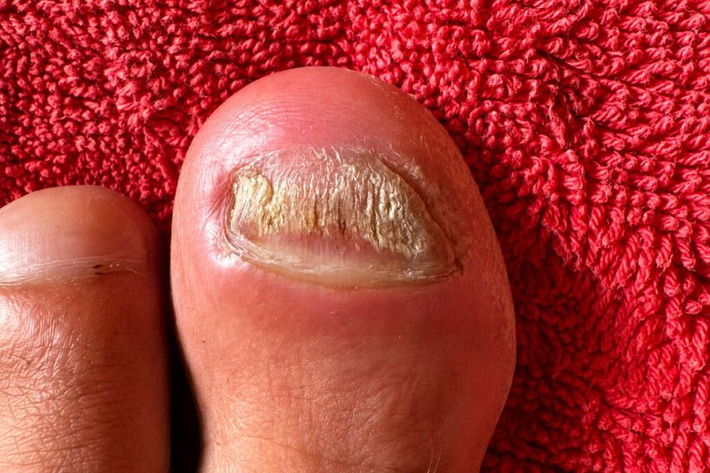 Dicker bröckeliger Zehennagel mit Nagelpilz