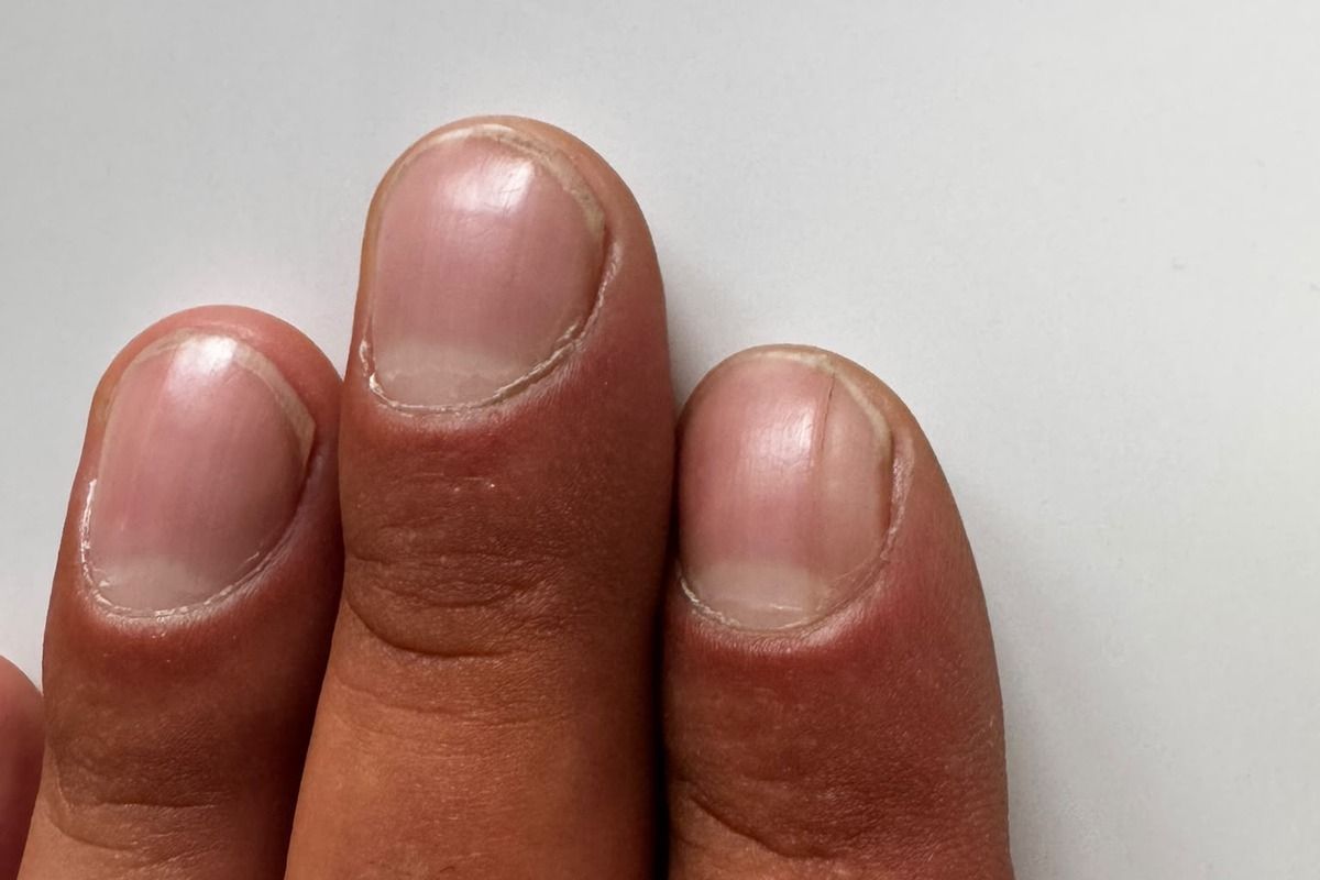 Fingernägel ohne deutlich sichtbare Nagelveränderungen als Vergleich