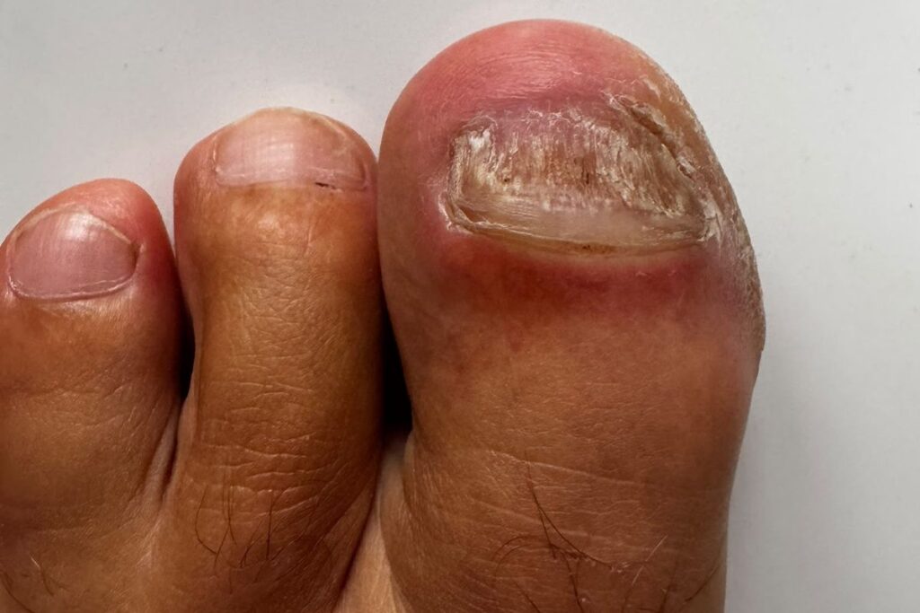 Grüner Nagel oder Nagelpilz bei verändertem Zehennagel