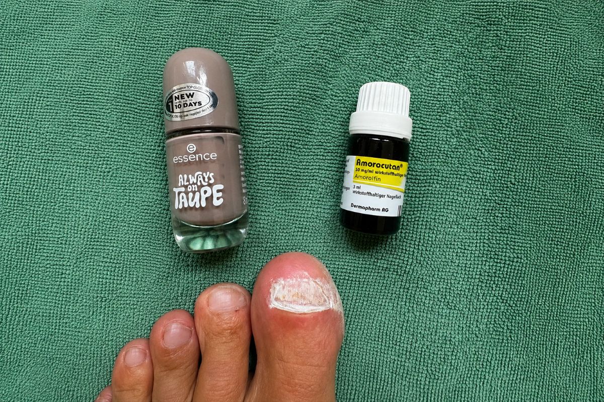 Nagellack bei Nagelpilz mit normalem Nagellack und Amorolfin