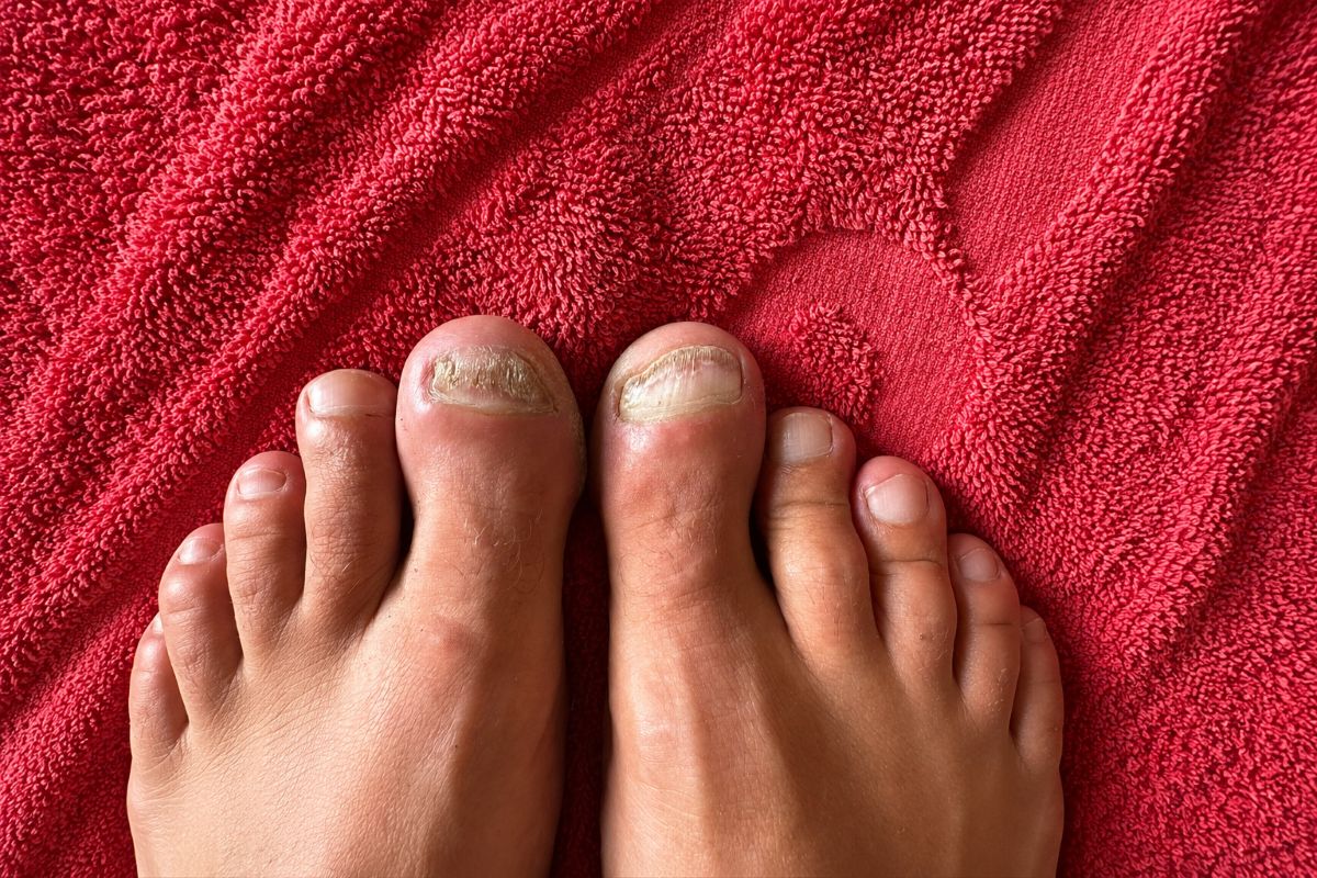 Nagelpilz oder Nagelpsoriasis bei veränderten Zehennägeln