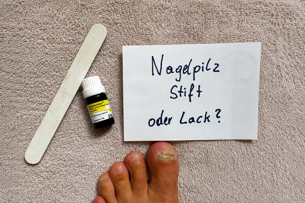 Nagelpilz Stift oder Lack bei betroffenem Zehennagel