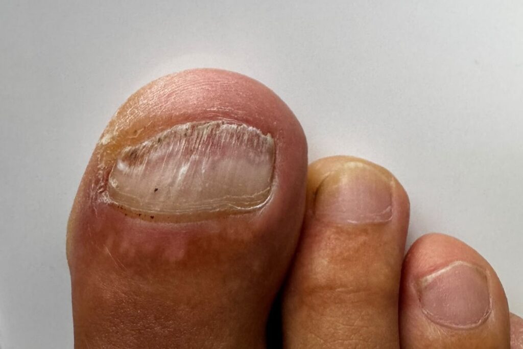 Tüpfelnägel oder Nagelpilz bei verändertem Zehennagel