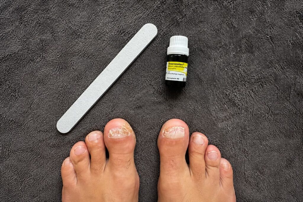 Nagelpilz Behandlung mit Amorolfin und Feile bei meinen Zehennägeln