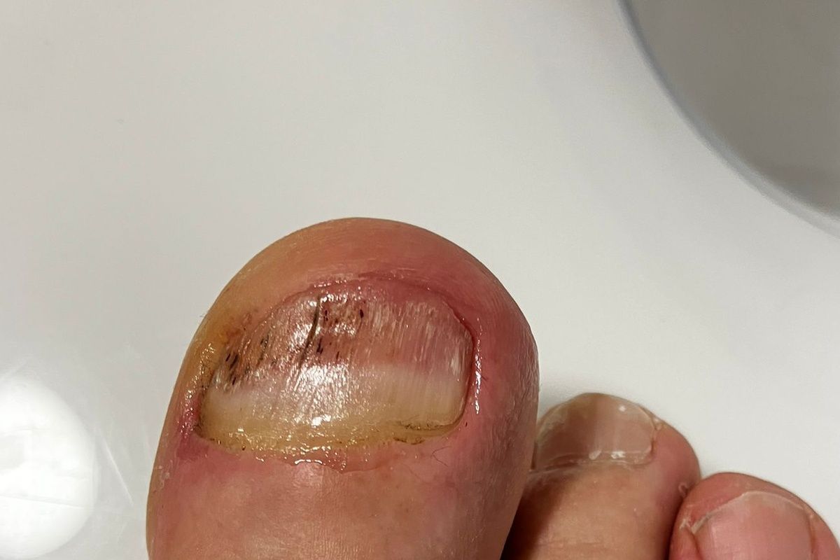 Nagelpilz Essig Vorher Nachher aus meiner eigenen Erfahrung