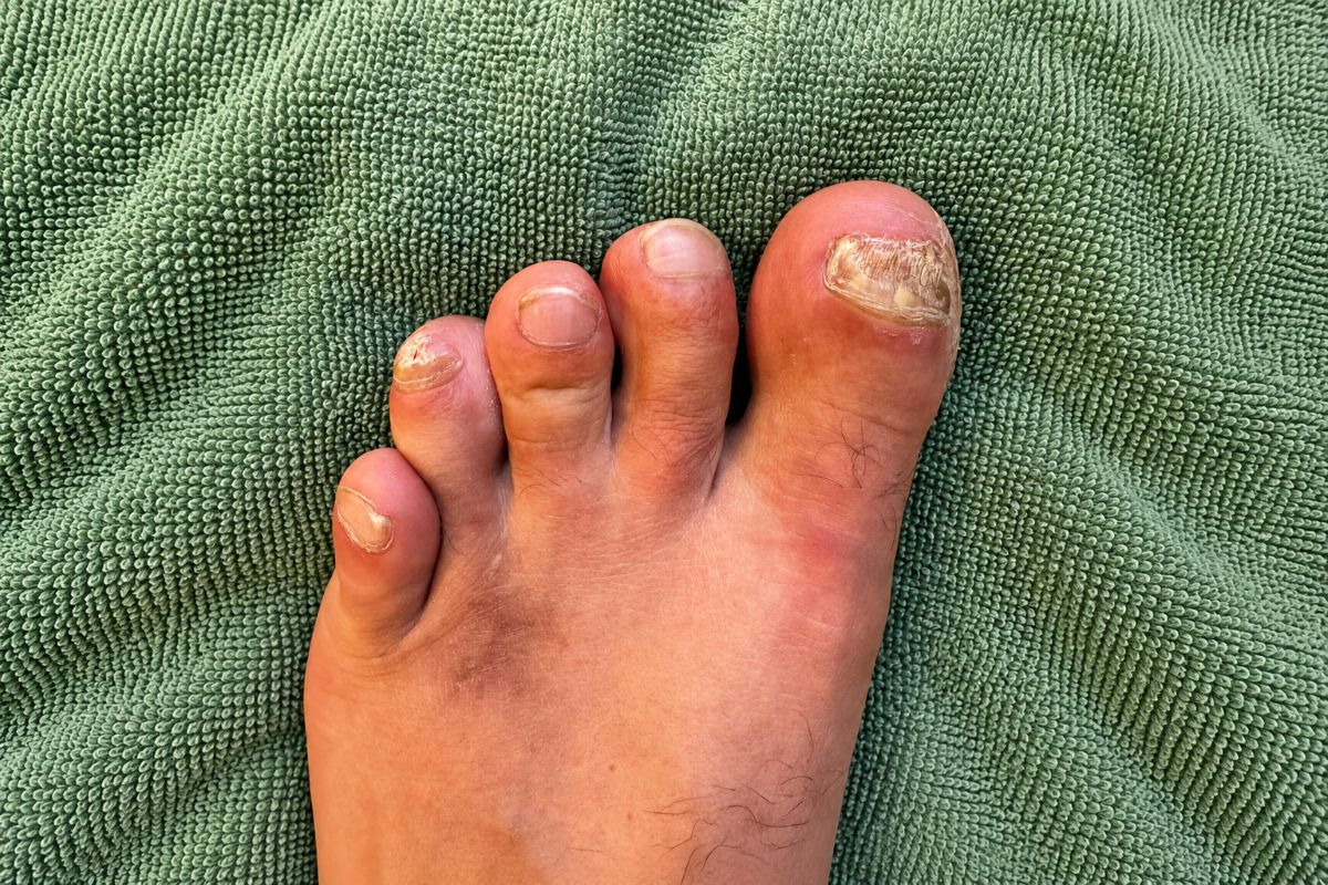 Nagelpilz am kleinen Zeh und Veränderungen an meinen Zehennägeln