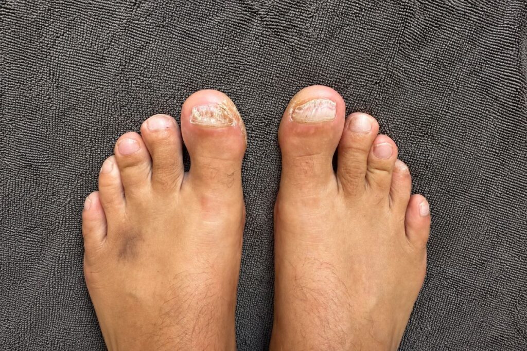 Nagelpilz am kleinen Zeh und mehrere Zehennägel im Vergleich