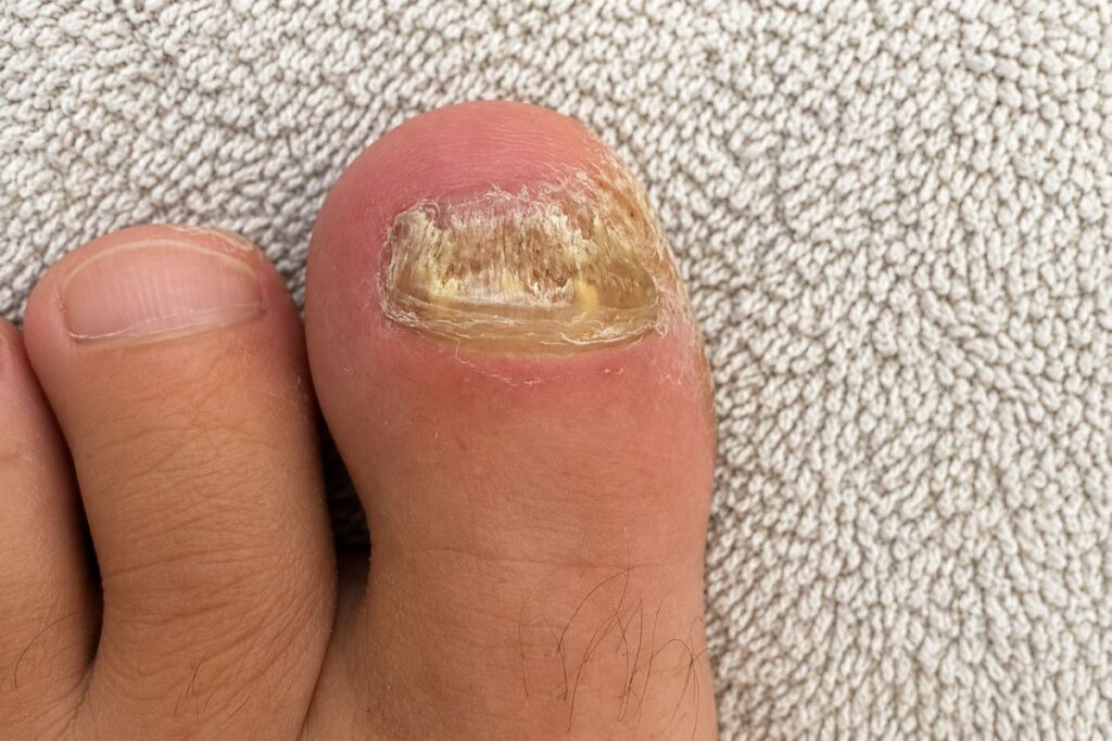 Veränderter Zehennagel mit Nagelpilz zur Abgrenzung einer Nagelbettentzündung