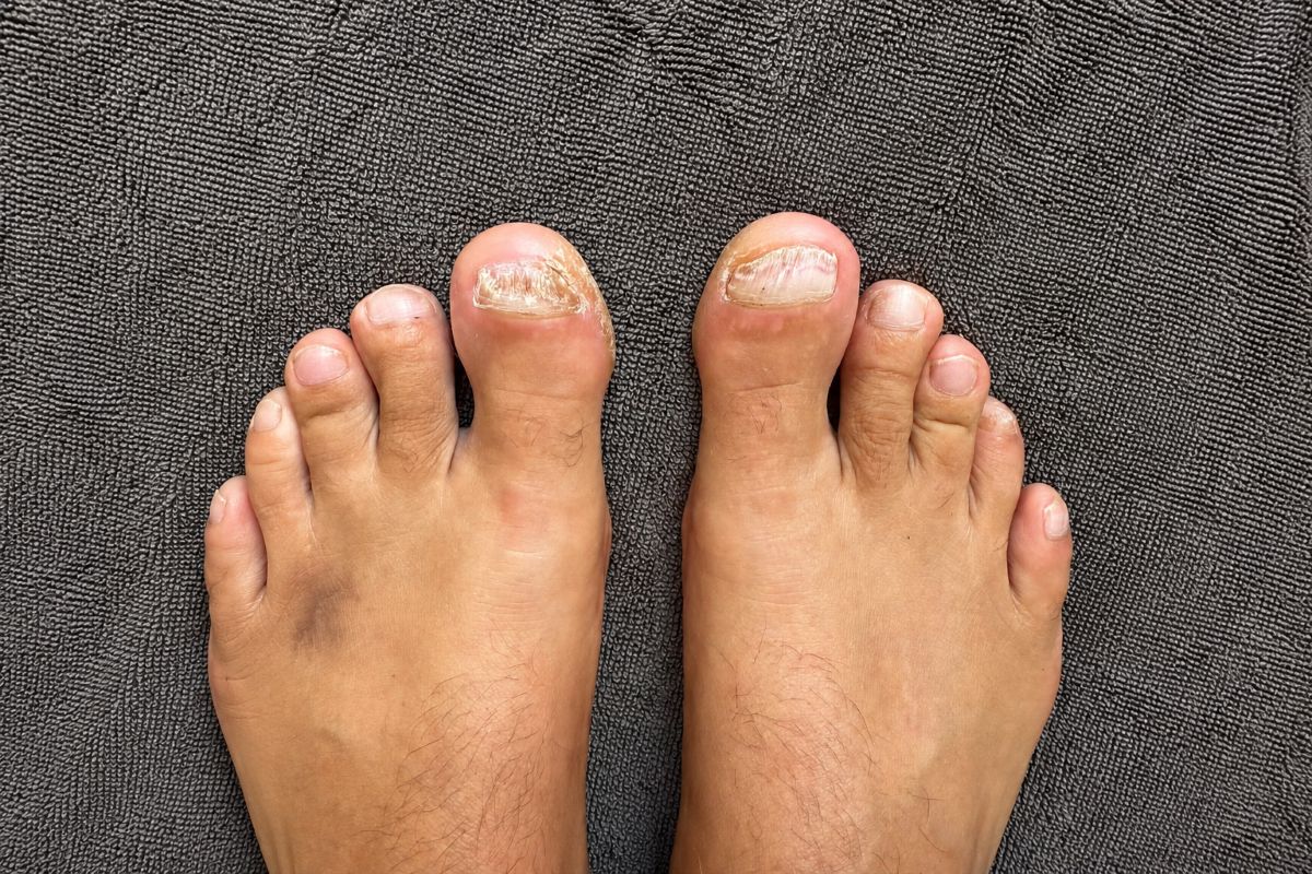 Nagelpilz unbehandelt mit mehreren veränderten Zehennägeln