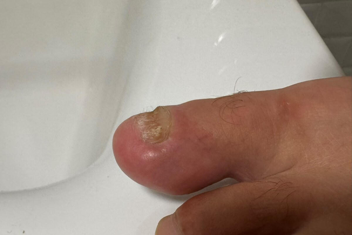Großer Zeh mit seitlich sichtbarem Nagelrand und angrenzender Haut