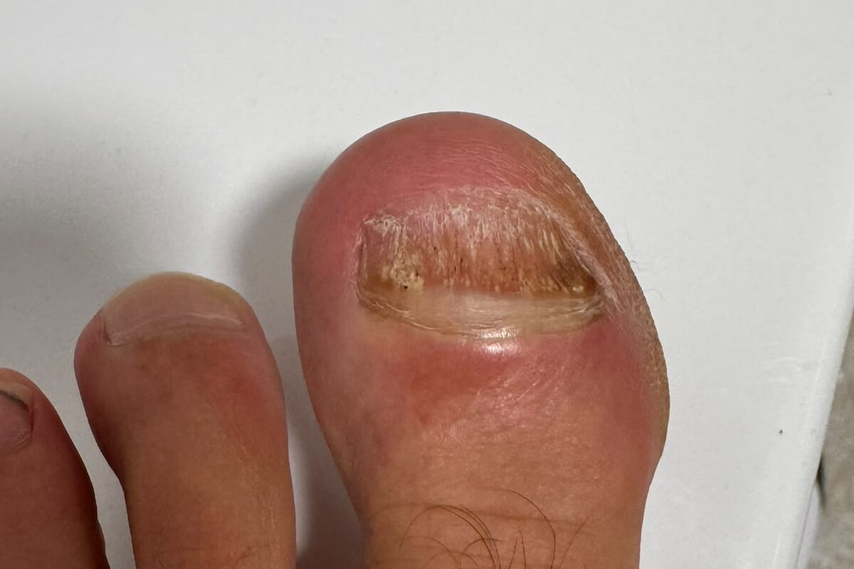 Veränderter großer Zehennagel von oben mit sichtbarer Nagelplatte und umgebender Haut