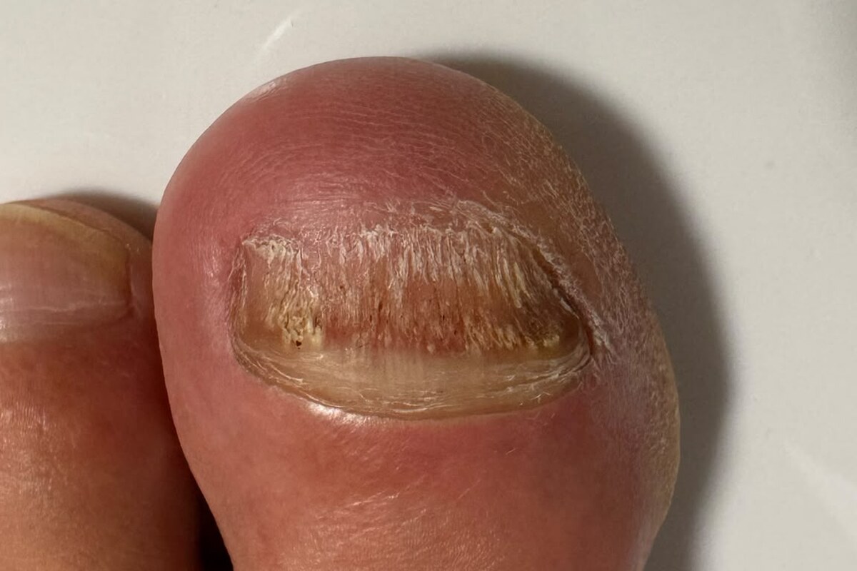 Nahaufnahme eines veränderten großen Zehennagels mit sichtbaren seitlichen Rändern